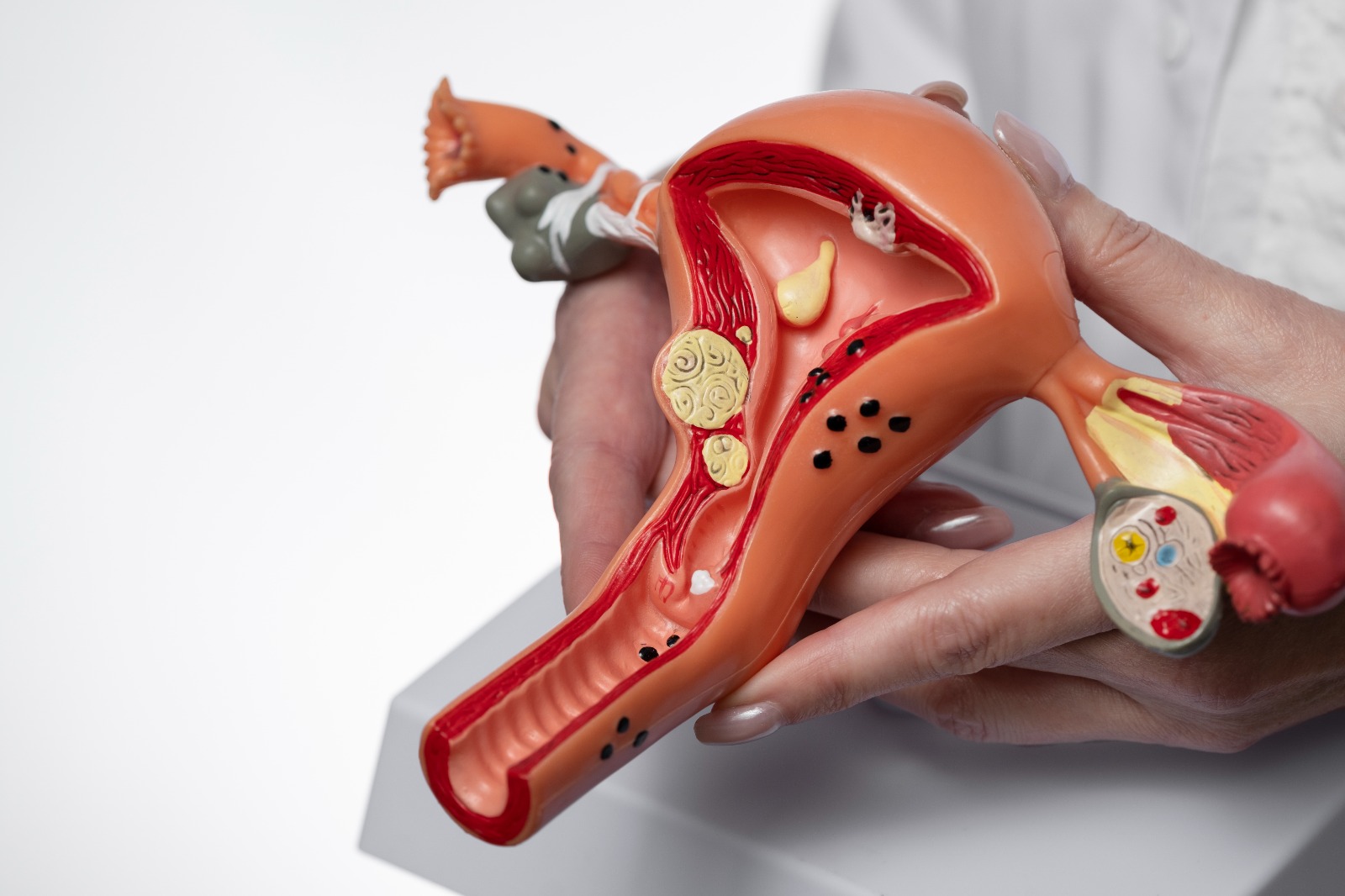 Modelo anatômico do útero — endometriose
